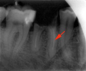 Tooth Xray