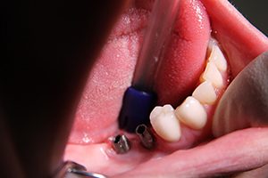 The triangular pewter looking objects are called Abutments. They are transferred over and screwed onto the implants (in the patient’s mouth) underneath the healing caps.