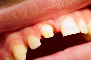 The Case for Dental Crowns
