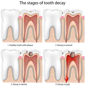Tooth-decay