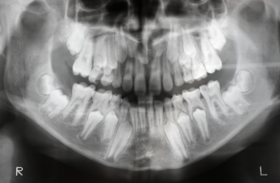 x-ray of jaw with teeth and milk teeth