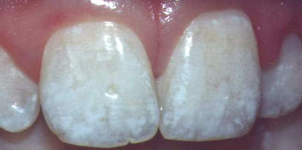 Fluoride Teeth Treatments