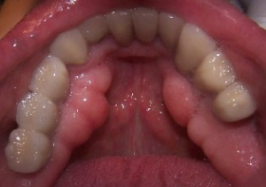 dental torus