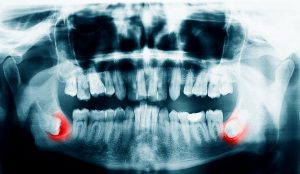 Xray scan of the teeth on the dark