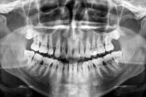 Dental scan x-ray of a 35 year old man.