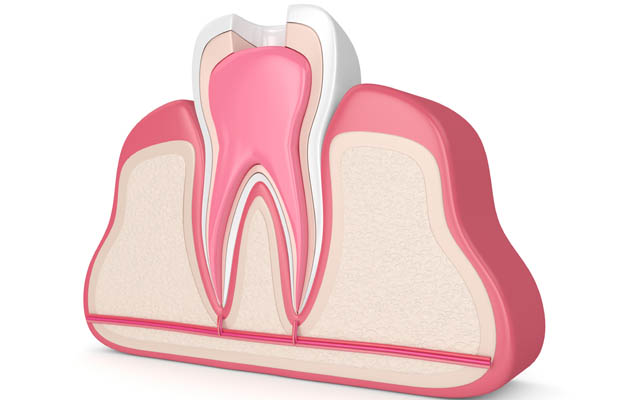 3d render of tooth with root canal treatment procedure