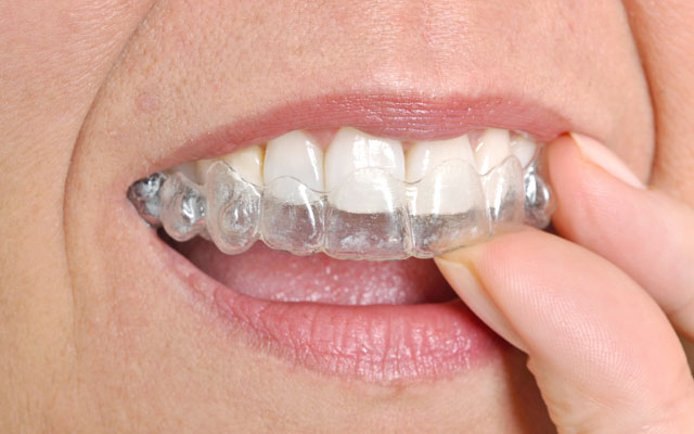 Invisalign Braces in Mouth