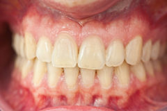 Periodontal and Gum Disease