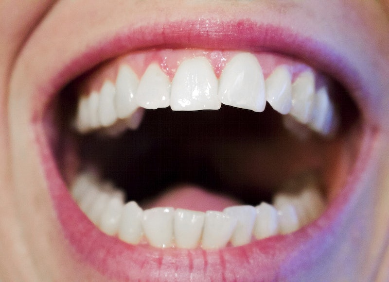 Icon Teeth Treatment to Remove Spots